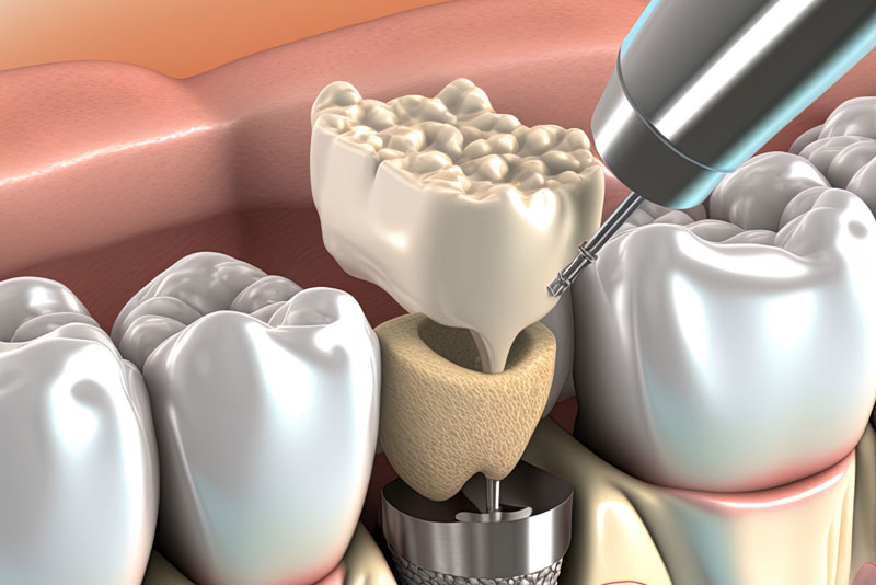 Featured image for “What Happens If I Don’t Have A Bone Grafting Procedure Before My Dental Implants Are Placed?”