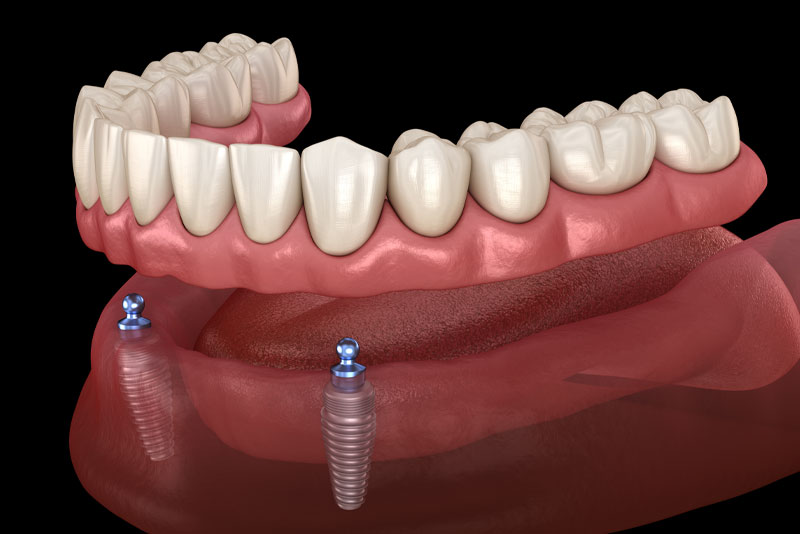 Featured image for “Am I A Candidate For Implant Supported Dentures? ”