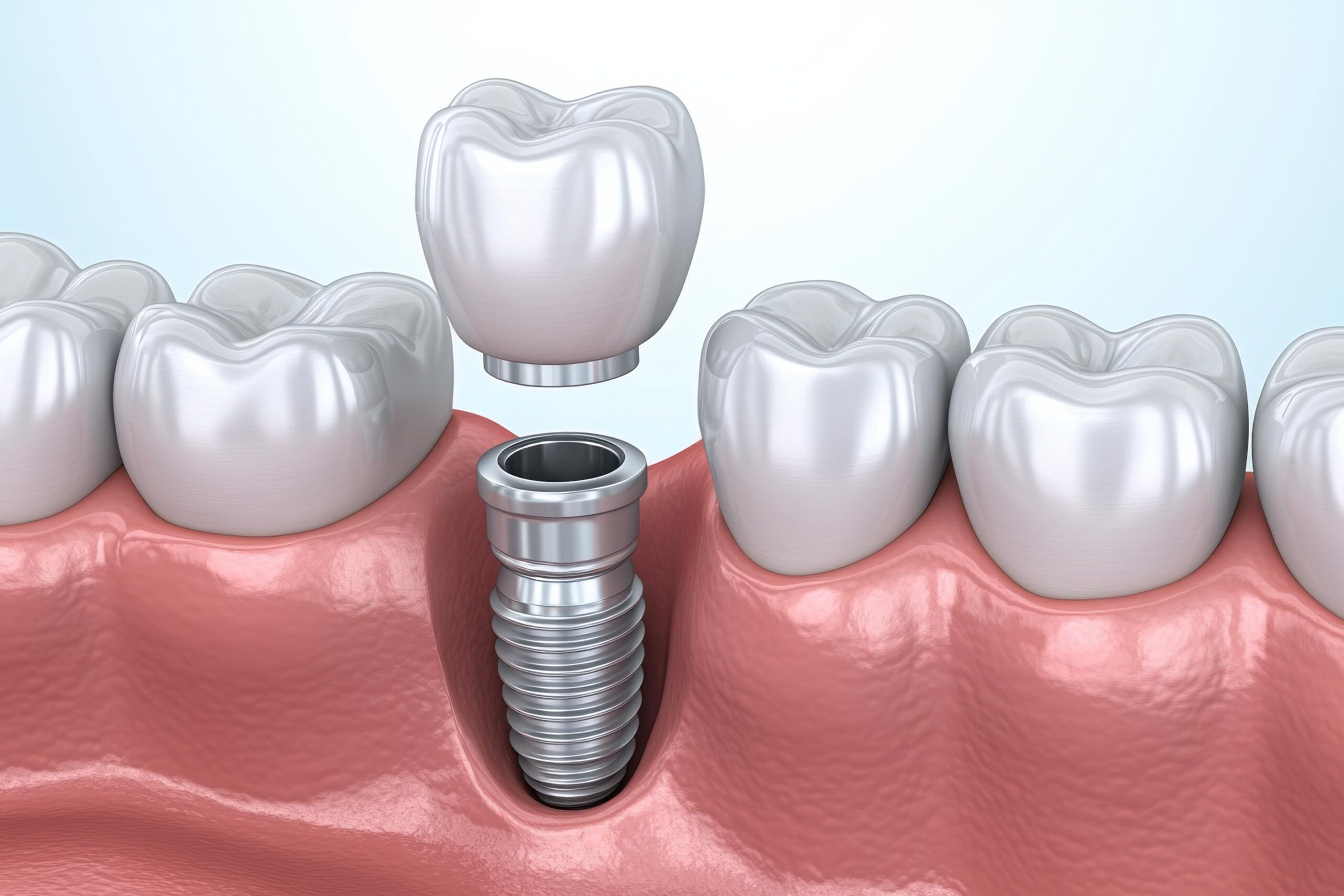 Featured image for “The Cost of Dental Implants: What to Expect and Financing Options Available”