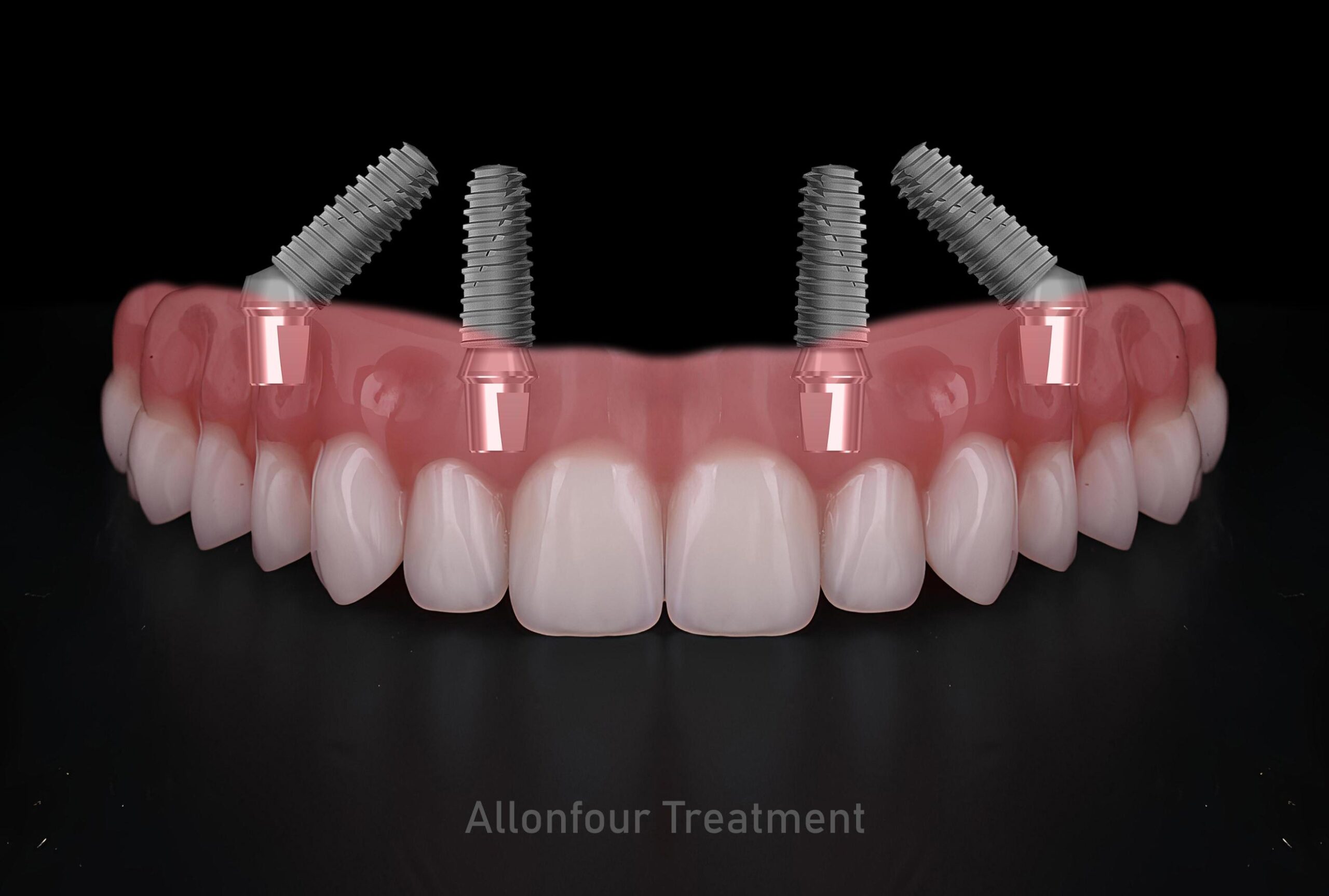 Featured image for “Dental Implants and Confidence: How a New Smile Can Change Your Life”