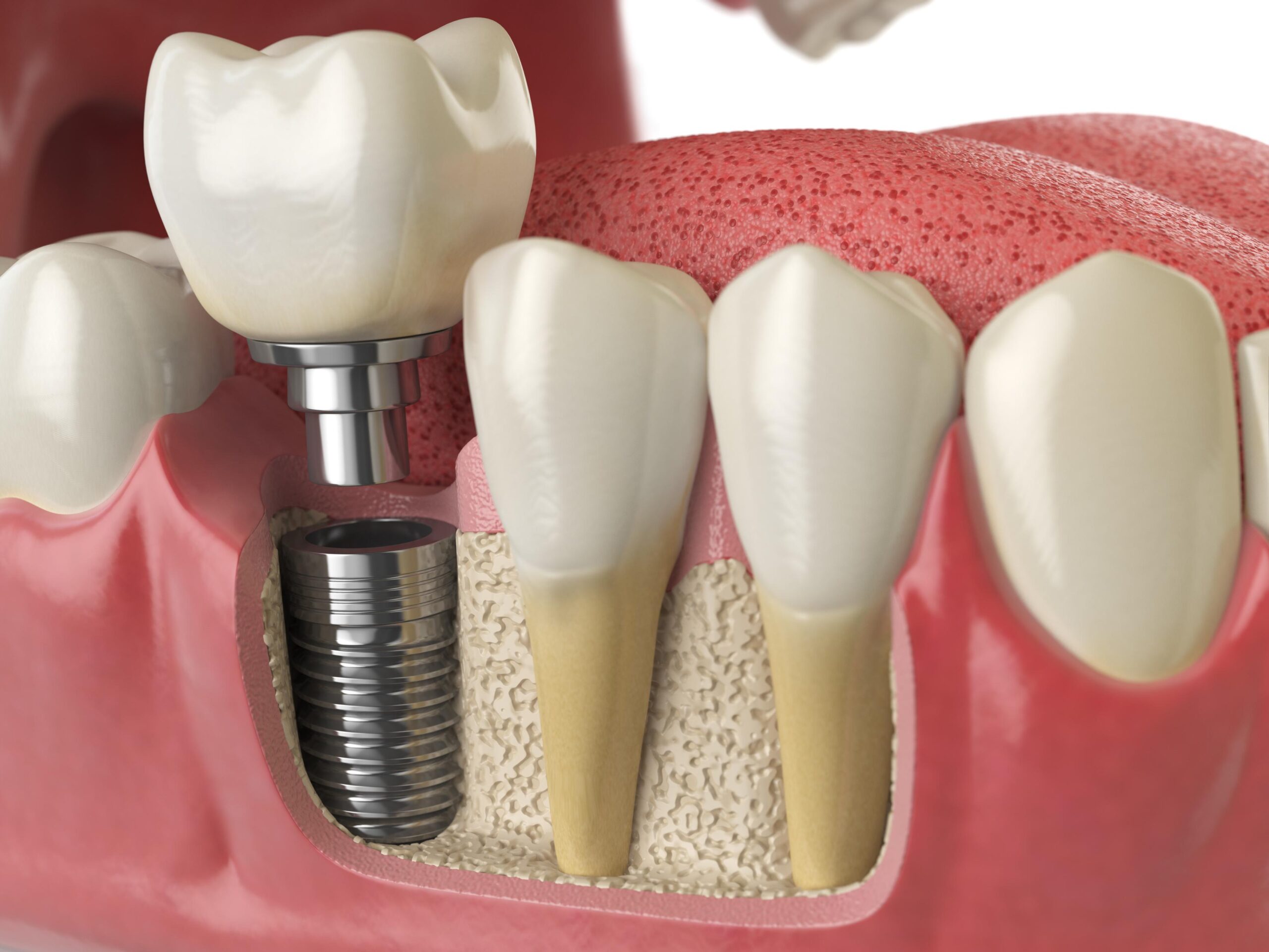Featured image for “How to Care for Your Dental Implants for a Lifetime of Healthy Smiles”