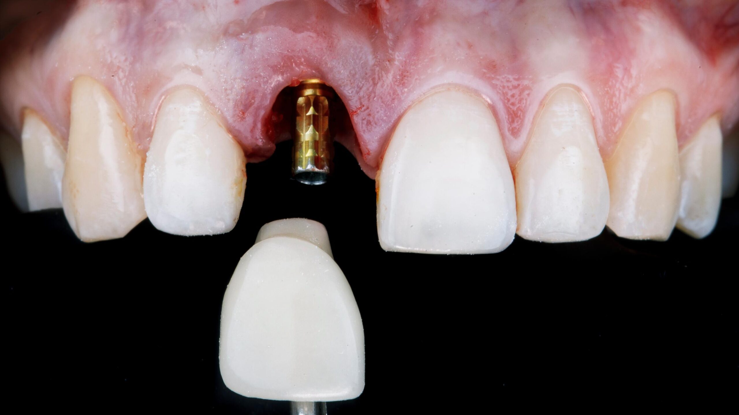 Featured image for “Top 7 Myths About Dental Implants — Debunked by a Specialist”