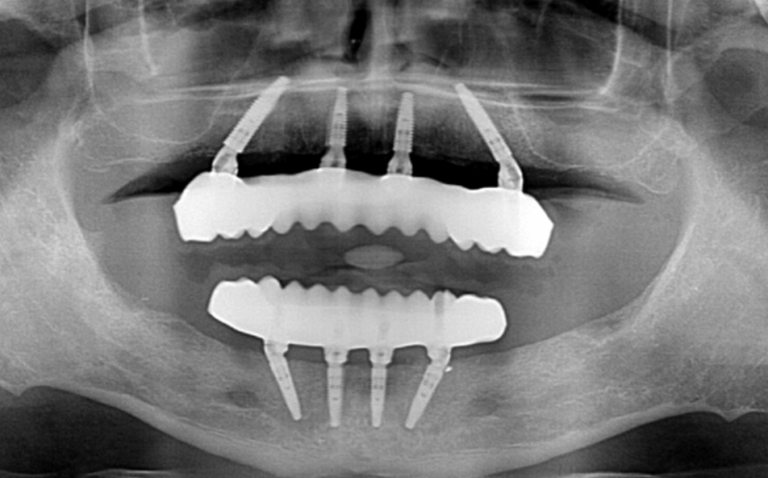 How Many Dental Implants Are Needed For A Full Mouth Dental Implant Procedure? 