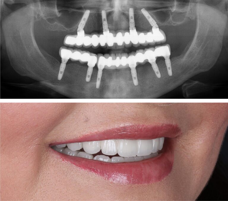 Are You a Candidate for Dental Implants? Let’s Find Out