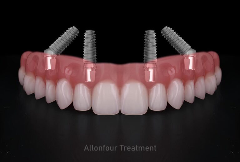 Dental Implants and Confidence: How a New Smile Can Change Your Life