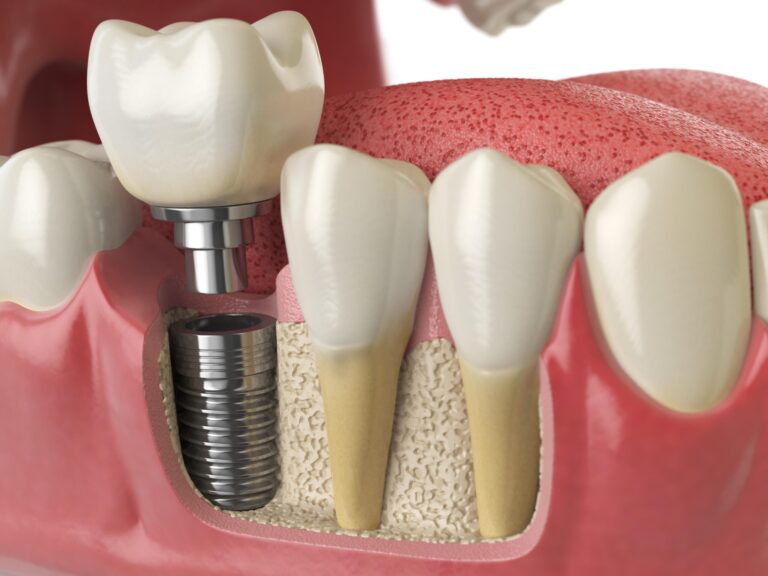 How to Care for Your Dental Implants for a Lifetime of Healthy Smiles