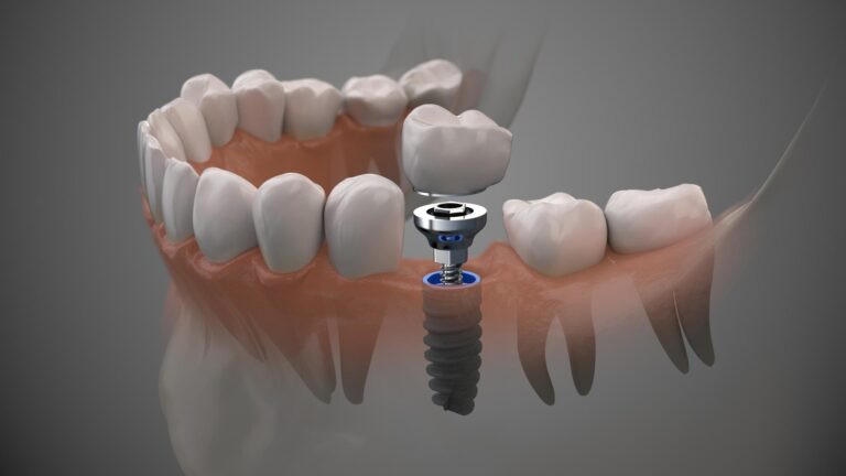 What Are Dental Implants? A Complete Guide 