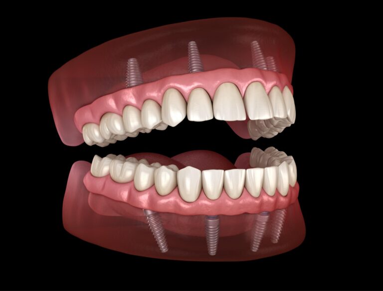 Dental Implants vs Dentures: Which Option Is Right for You?