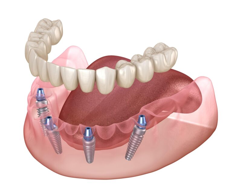 Am I a Candidate for Dental Implants? What You Need to Know