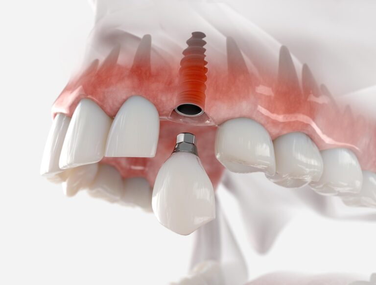 A Step-by-Step Guide to the Dental Implant Process at Pixel Dental