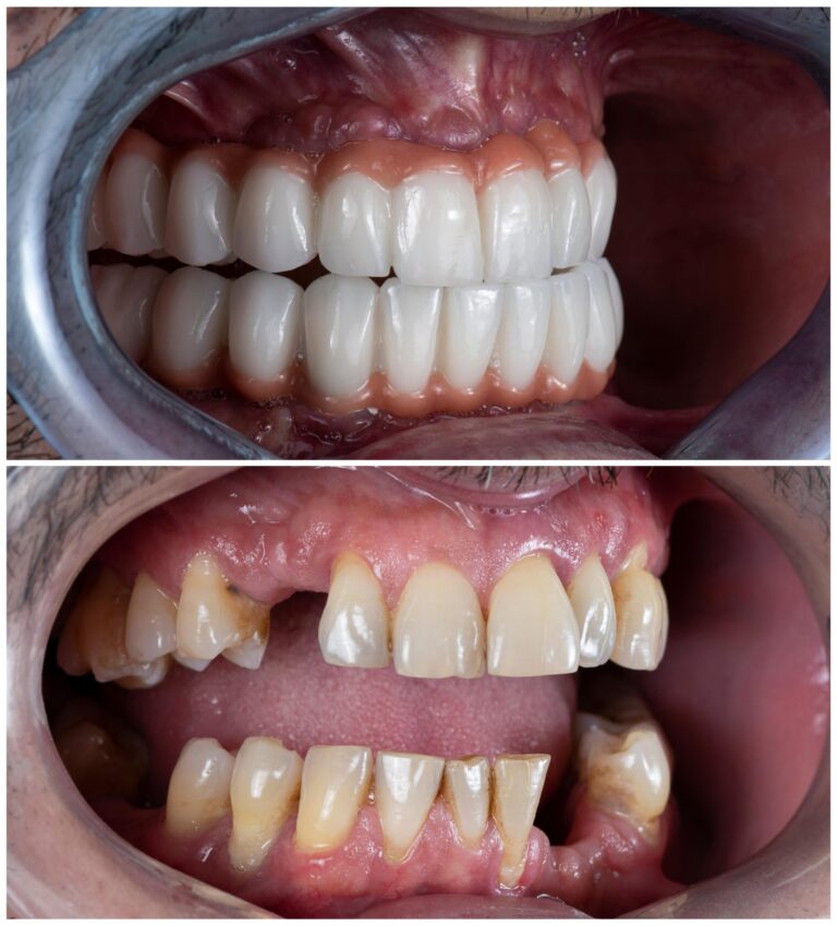 Why Dental Implants Are the Gold Standard for Replacing Missing Teeth