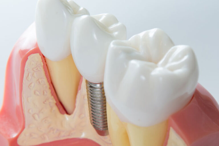 Why Many Patients Prefer Private Dental Practices Over Large Corporate Implant Centers